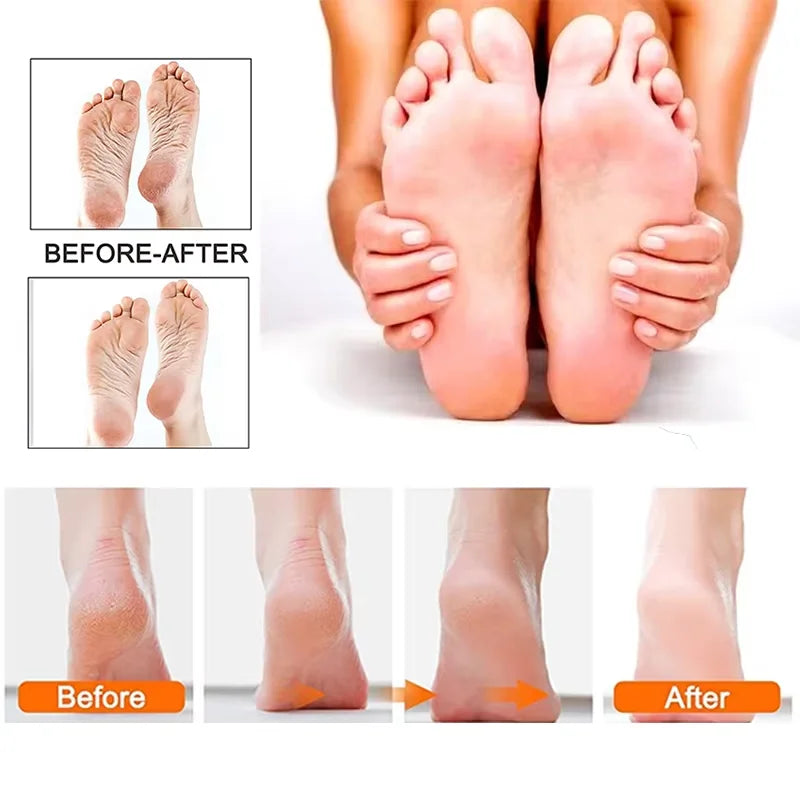 Before and after comparison showing smoother-looking heels after using the Meroria Pedicure Kit Pro