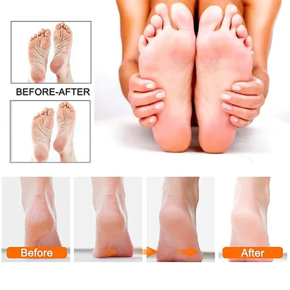 Before and after comparison showing smoother-looking heels after using the Meroria Pedicure Kit Pro